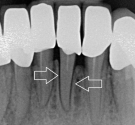 Radiografie dentară care arată rădăcinile incisivilor centrali cu săgeți indicând direcția acestora.
