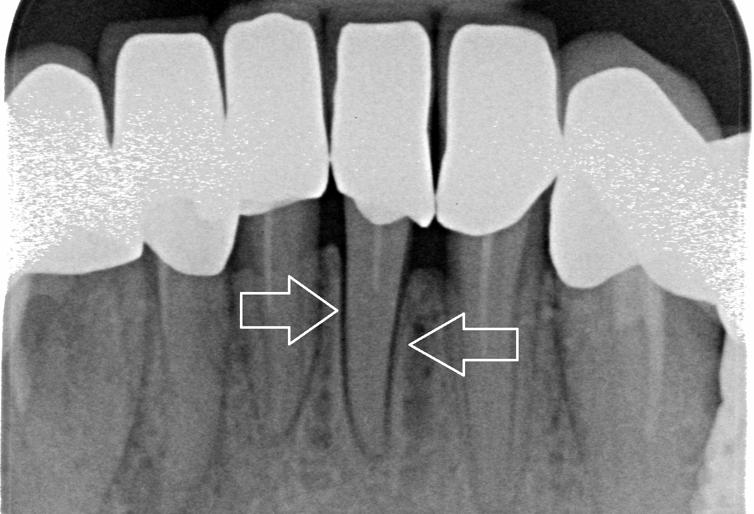 Radiografie dentară care arată rădăcinile incisivilor centrali cu săgeți indicând direcția acestora.