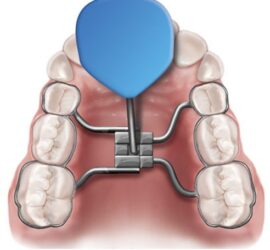 Aparat de expansiune dentară cu un suport albastru și componente metalice pentru ajustare.