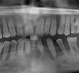Radiografie dentară care arată dinții maxilarului inferior și structura acestora.