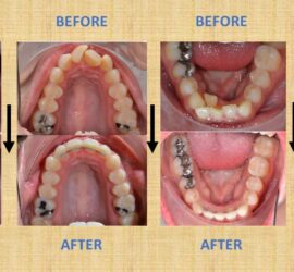 Imagini comparative înainte și după tratamentul ortodontic, prezentând modificări dentare.