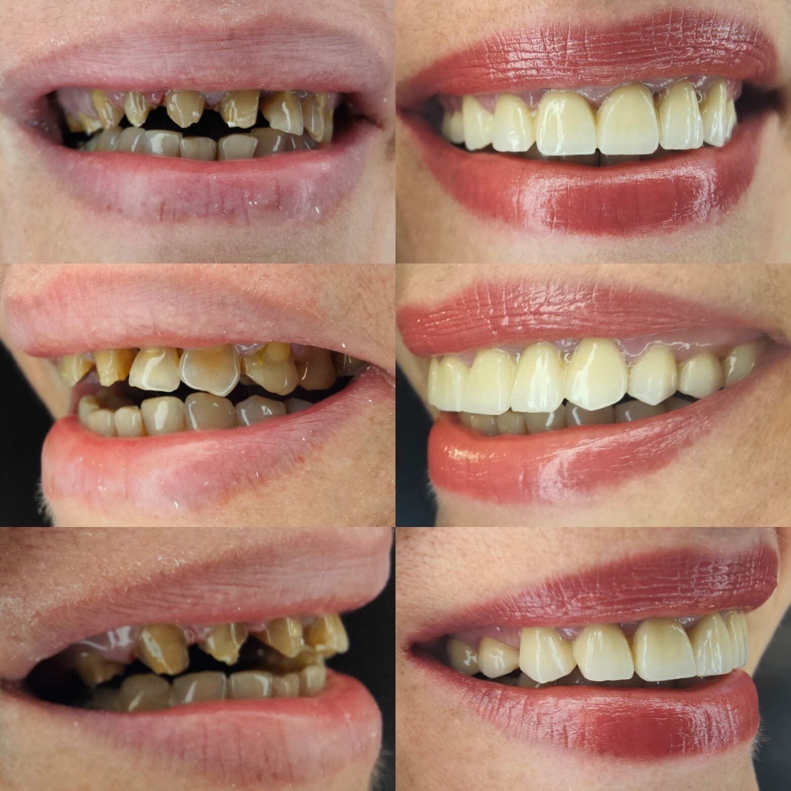 Dental crowns in Bucharest