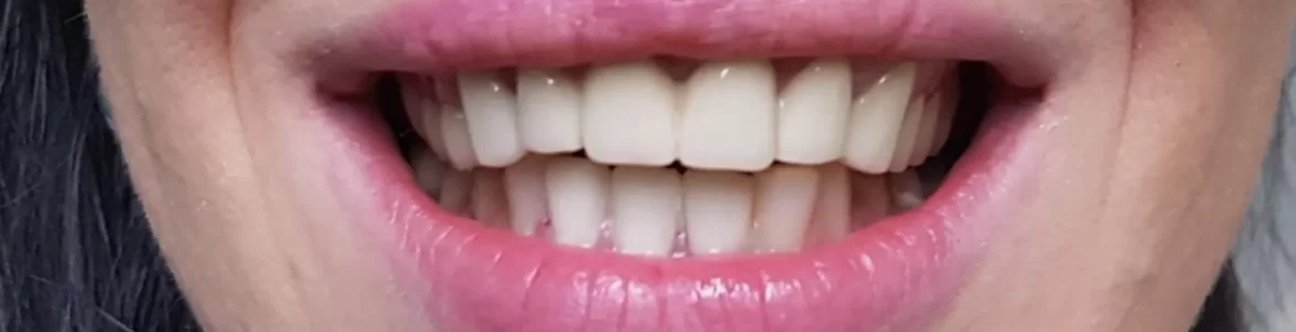 coroane dentare zirconiu