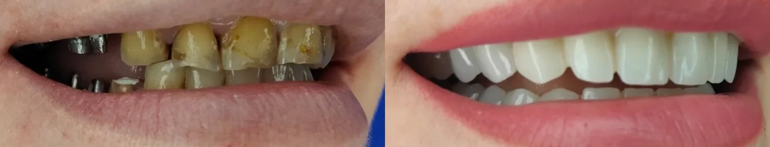 coroane dentare zirconiu