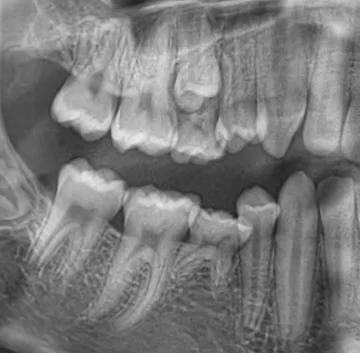 anodontie premolar 45
